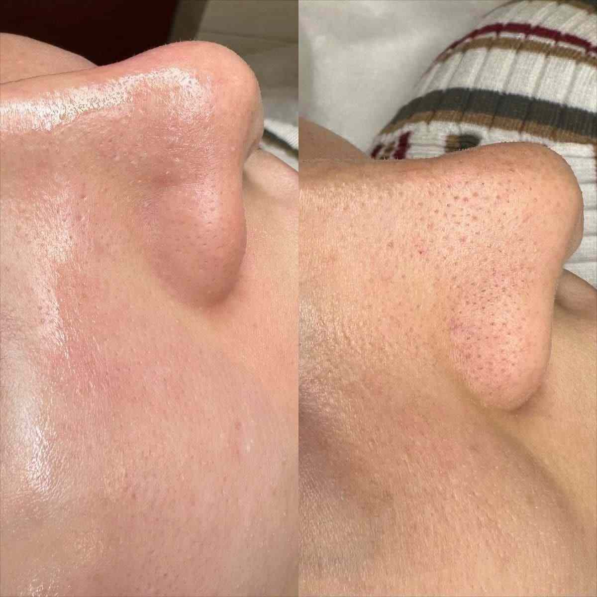 Limpieza facial profunda en casa